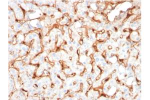 Formalin-fixed, paraffin-embedded human Hepatocellular Carcinoma stained with C1QB Mouse Monoclonal Antibody (C1QB/2965). (C1QB Antikörper  (AA 41-188))