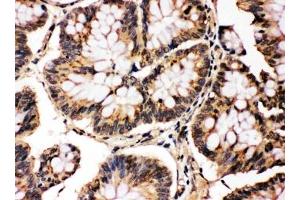 IHC testing of FFPE human intestinal cancer with MAPK8/9 antibody. (MAPK8 / MAPK9 (Middle Region) Antikörper)