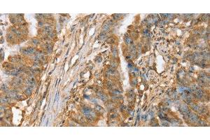 Immunohistochemistry of paraffin-embedded Human esophagus cancer tissue using SLC41A2 Polyclonal Antibody at dilution 1:45 (SLC41A2 Antikörper)