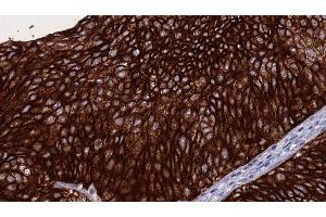 ABIN6276284 at 1/100 staining Human urothelial cancer tissue by IHC-P. (Perforin 1 Antikörper  (N-Term))