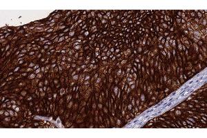 ABIN6276284 at 1/100 staining Human urothelial cancer tissue by IHC-P.