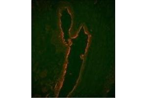 Immunofluorescence analysis of LTF Monoclonal Antibody with paraffin-embedded human prostate carcinoma tissue. (Lactoferrin Antikörper)