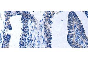 Immunohistochemistry of paraffin-embedded Human prost at e cancer tissue using PROC Polyclonal Antibody at dilution of 1:80(x200) (PROC Antikörper)