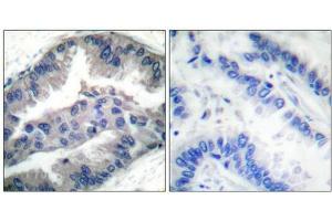 Immunohistochemical analysis of paraffin-embedded human lung carcinoma tissue, using BIK (Phospho-Thr33) antibody.
