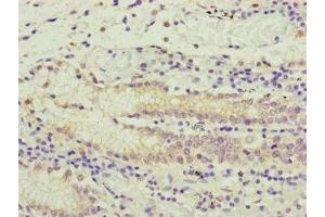 Immunohistochemistry of paraffin-embedded human gastric cancer using ABIN7166519 at dilution of 1:100 (PCDHA12 Antikörper  (AA 862-941))