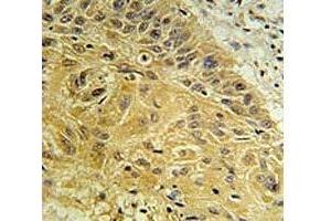 WNT5A antibody immunohistochemistry analysis in formalin fixed and paraffin embedded human lung carcinoma. (WNT5A Antikörper  (AA 185-213))