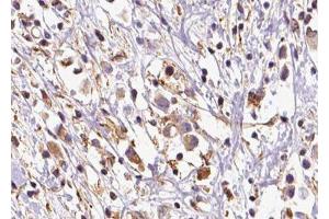 ABIN6279776 at 1/100 staining Human breast cancer tissue by IHC-P. (ARHGEF6 Antikörper  (N-Term))