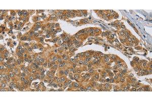 Immunohistochemistry of paraffin-embedded Human breast cancer tissue using ERK 3 Polyclonal Antibody at dilution 1:40 (MAPK6 Antikörper)