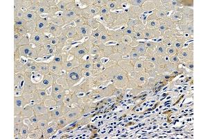 ABIN7096957 and ABIN7101024 at 1/100 staining human liver cancer by IHC-P. (TM4SF4 Antikörper)