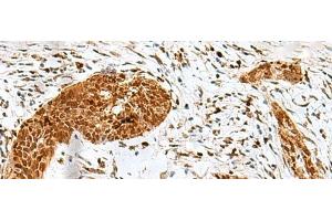 Immunohistochemistry of paraffin-embedded Human esophagus cancer tissue using HMG20A Polyclonal Antibody at dilution of 1:25(x200) (HMG20A Antikörper)