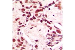 Immunohistochemical analysis of Lamin A/C staining in human breast cancer formalin fixed paraffin embedded tissue section. (Lamin A/C Antikörper  (Center))