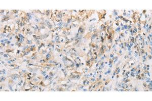 Immunohistochemistry of paraffin-embedded Human gasrtic cancer tissue using NPPC Polyclonal Antibody at dilution 1:70 (NPPC Antikörper)