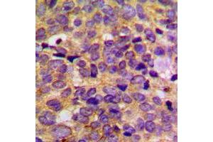 Immunohistochemical analysis of PRKAR2B staining in human breast cancer formalin fixed paraffin embedded tissue section. (PRKAR2B Antikörper  (Center))