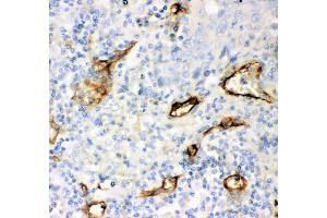 Anti- CD146 antibody, IHC(P) IHC(P): Human Lung Cancer Tissue (MCAM Antikörper  (AA 59-401))