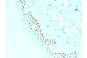 Formalin-fixed, paraffin-embedded human Basal Cell Carcinoma stained with p63 Mouse Monoclonal Antibody (TP63/2428). (p63 Antikörper)