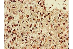 IHC image of ABIN7173856 diluted at 1:400 and staining in paraffin-embedded human glioma performed on a Leica BondTM system. (NGFR Antikörper  (AA 277-391))