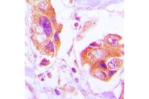 Immunohistochemical analysis of Filamin A (pS2152) staining in human lung cancer formalin fixed paraffin embedded tissue section. (Filamin A Antikörper  (C-Term, pSer2152))
