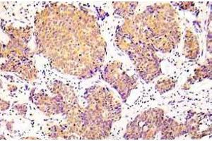 Immunohistochemistry (IHC) analyzes of p-COFILN1 (pSer3) antibody in paraffin-embedded human lung adenocarcinoma tissue. (Cofilin Antikörper  (pSer3))