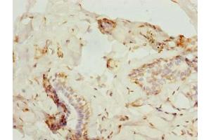 Immunohistochemistry of paraffin-embedded human breast cancer using ABIN7176183 at dilution of 1:100 (ZNF232 Antikörper  (AA 1-417))