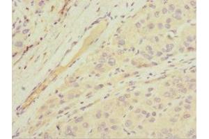 Immunohistochemistry of paraffin-embedded human liver cancer using ABIN7143763 at dilution of 1:100 (MGAT1 Antikörper  (AA 156-445))