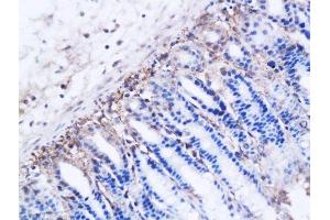 Formalin-fixed and paraffin embedded ovarian cancer xenograft labeled with Anti-DBC2 receptor Polyclonal Antibody, Unconjugated  followed by conjugation to the secondary antibody and DAB staining (RHOBTB2 Antikörper  (AA 631-727))