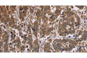 Immunohistochemistry of paraffin-embedded Human liver cancer tissue using FBP2 Polyclonal Antibody at dilution 1:40 (FBP2 Antikörper)