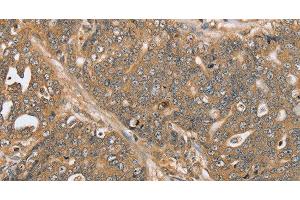 Immunohistochemistry of paraffin-embedded Human ovarian cancer using PTPN20 Polyclonal Antibody at dilution of 1:30 (PTPN20 Antikörper)