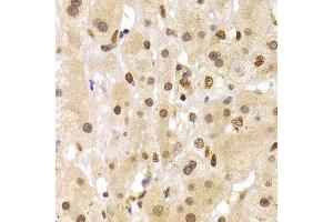 Immunohistochemistry of paraffin-embedded human liver cancer using HNRNPA1 Antibody (ABIN5975570) at dilution of 1/100 (40x lens). (HNRNPA1 Antikörper)