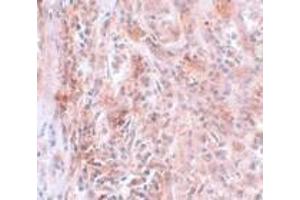 Immunohistochemistry of BCAS2 in human breast carcinoma with BCAS2 antibody at 5 μg/ml. (BCAS2 Antikörper  (C-Term))