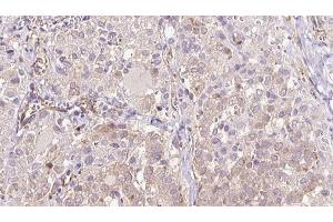 ABIN6273315 at 1/100 staining Human thyroid cancer tissue by IHC-P. (SEC63 Antikörper  (C-Term))
