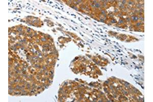 The image on the left is immunohistochemistry of paraffin-embedded Human liver cancer tissue using ABIN7192428(SLC22A3 Antibody) at dilution 1/25, on the right is treated with synthetic peptide. (SLC22A3 Antikörper)
