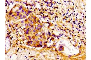 Immunohistochemistry of paraffin-embedded human breast cancer using ABIN7148919 at dilution of 1:100 (CDKN3 Antikörper  (AA 1-172))