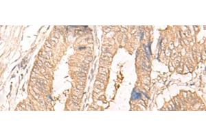 Immunohistochemistry of paraffin-embedded Human colorectal cancer tissue using IL24 Polyclonal Antibody at dilution of 1:30(x200) (IL-24 Antikörper)