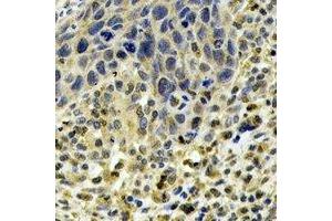 Immunohistochemical analysis of ABO staining in human esophageal cancer formalin fixed paraffin embedded tissue section.