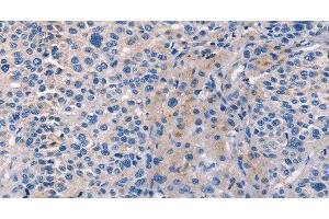 Immunohistochemistry of paraffin-embedded Human liver cancer tissue using CD5L Polyclonal Antibody at dilution 1:40 (CD5L Antikörper)