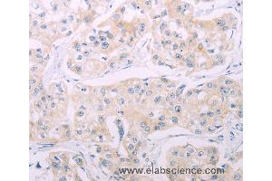 Immunohistochemistry of Human breast cancer using ADCY7 Polyclonal Antibody at dilution of 1:60 (ADCY7 Antikörper)