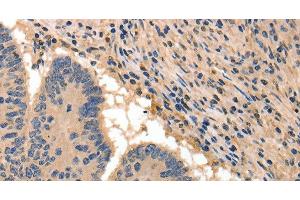 Immunohistochemistry of paraffin-embedded Human colon cancer tissue using BAIAP2 Polyclonal Antibody at dilution 1:50 (BAIAP2 Antikörper)