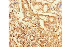 Immunohistochemistry of paraffin-embedded human pancreatic cancer using ABIN7176457 at dilution of 1:100 (ZNF627 Antikörper  (AA 1-300))