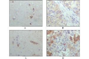 Immunohistochemical analysis of paraffin-embedded human brain hippocampus (A), lung cancer (B), brain tumor (C), breast cance (D), showing cytoplasmic localization with DAB staining using CRYAB mouse mAb.