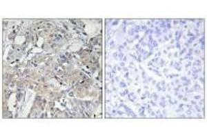 Immunohistochemistry analysis of paraffin-embedded human breast carcinoma tissue using Collagen VI α3 antibody. (COL6a3 Antikörper)