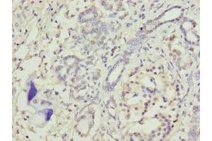 Immunohistochemistry of paraffin-embedded human pancreatic cancer using ABIN7172914 at dilution of 1:100 (TRAM2 Antikörper  (AA 316-370))