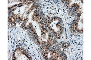 Immunohistochemical staining of paraffin-embedded Adenocarcinoma of colon tissue using anti-NIT2 mouse monoclonal antibody. (NIT2 Antikörper)