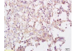 Formalin-fixed and paraffin embedded human breast carcinoma labeled with Anti eIF3A Polyclonal Antibody, Unconjugated (ABIN704891) at 1:200 followed by conjugation to the secondary antibody and DAB staining (UBR1 Antikörper  (AA 801-900))
