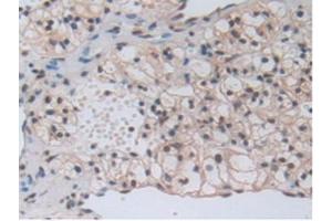 IHC-P analysis of Human Kidney Cancer Tissue, with DAB staining. (beta-Thromboglobulin Antikörper  (AA 59-128))