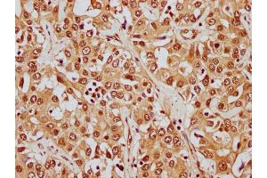 IHC image of nphHU diluted at 1:8 and staining in paraffin-embedded human liver cancer performed on a Leica BondTM system. (HIST1H1E Antikörper  (AA 21-33))