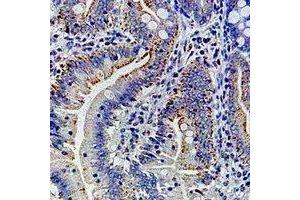 Immunohistochemical analysis of Ribophorin-1 staining in human colon cancer formalin fixed paraffin embedded tissue section. (RPN1 Antikörper)