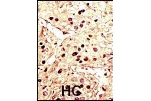 Formalin-fixed and paraffin-embedded human cancer tissue reacted with the primary antibody, which was peroxidase-conjugated to the secondary antibody, followed by DAB staining. (Aurora-B (ARK/STK12) (AA 6-35), (N-Term) Antikörper)