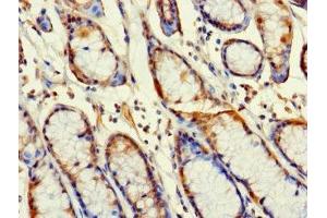 Immunohistochemistry of paraffin-embedded human gastric cancer using ABIN7166961 at dilution of 1:100 (RABGAP1L Antikörper  (Isoform 10))
