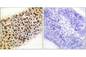 Immunohistochemistry analysis of paraffin-embedded human liver carcinoma tissue, using TIP60 (Ab-86) Antibody. (KAT5 Antikörper  (AA 52-101))