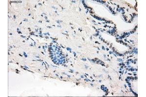 Immunohistochemical staining of paraffin-embedded Adenocarcinoma of colon tissue using anti-MAP2K1 mouse monoclonal antibody. (MEK1 Antikörper)